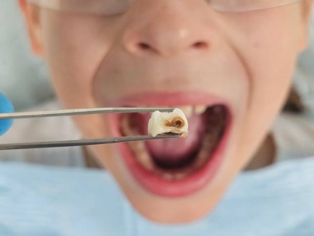 Best Emergency Dental Extractions in Williamsburg, FL